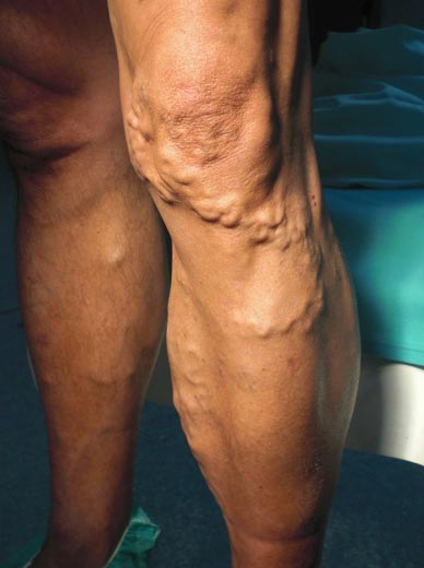 Los análisis a la tromboflebitis de las extremidades inferiores